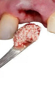 Bone Grafts & Membranes