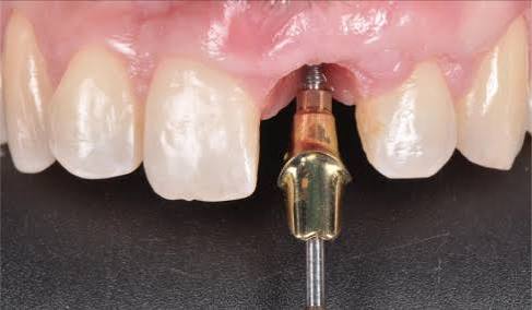 Aesthetic Abutment