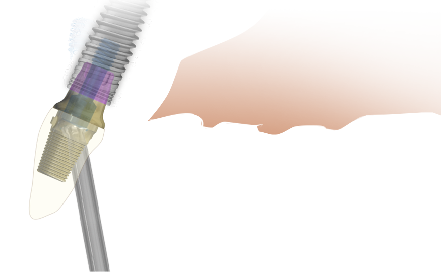 Angled Screw Channel Prosthetic Screw | SP | Seven & Lance Plus Compatible | MIS