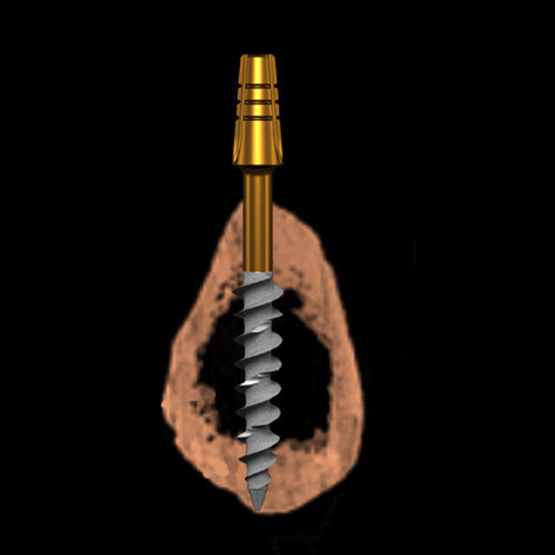 Compressive Implant | C-Series | I-Fix | One Piece Implant | ImplantsKart