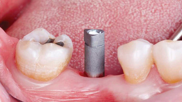 Scan Body / Abutment