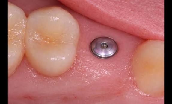 Cover Screw