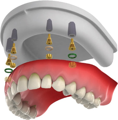 Implant Keeper | Tissue Level | Dome | 5.5mm | Bright | Dentium