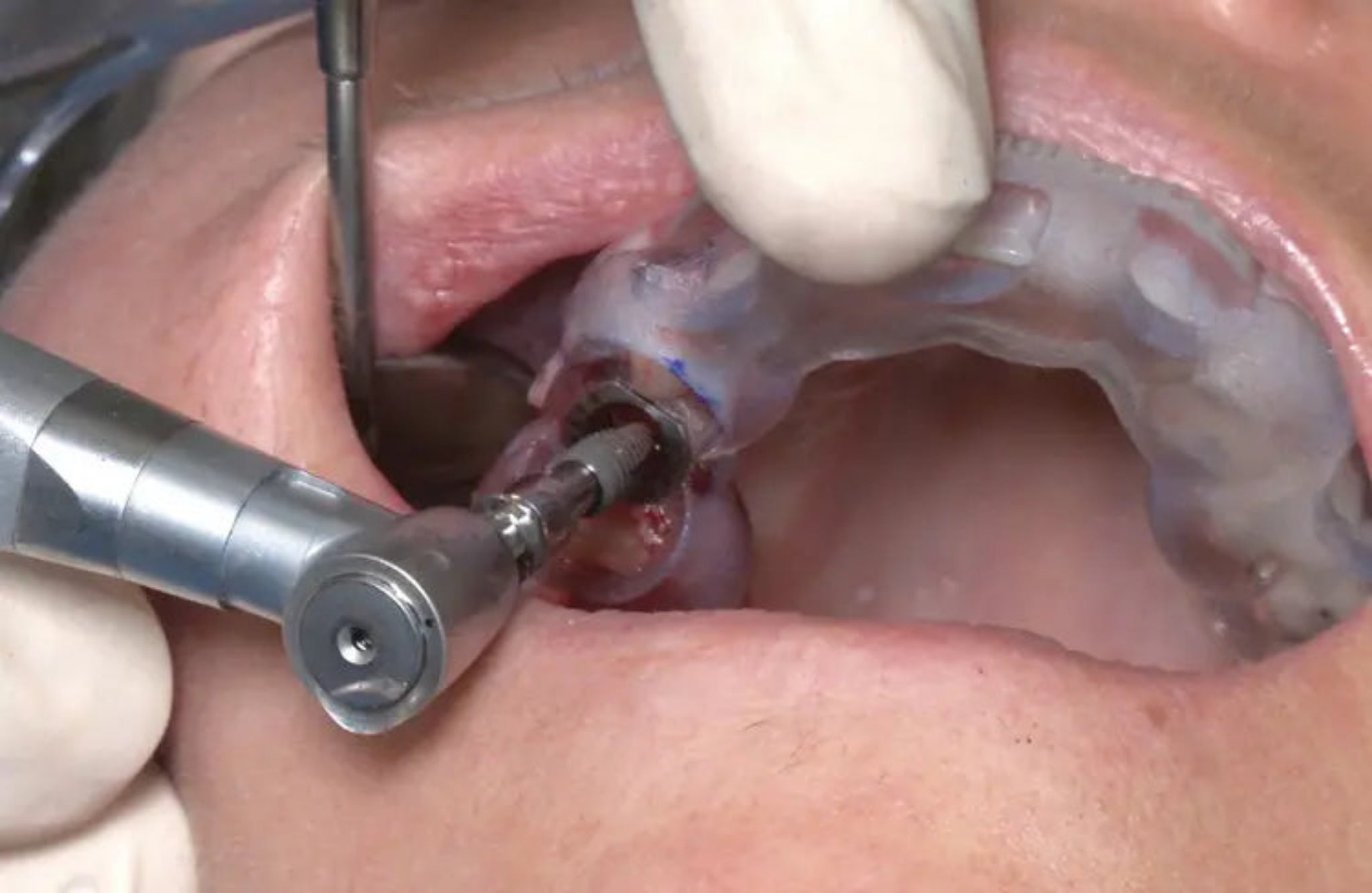 ADIN Touareg OS Dental Implant | Without Abutment | ImplantsKart
