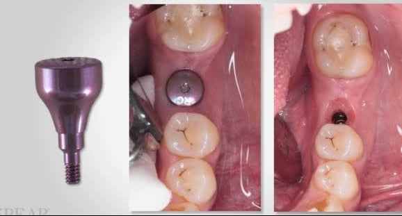 Healing Abutment