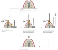 SOS Broken Screw Kit | MIS Seven & Lance Plus Compatible | ImplantsKart
