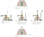 SOS Broken Screw Kit | MIS Seven & Lance Plus Compatible | ImplantsKart
