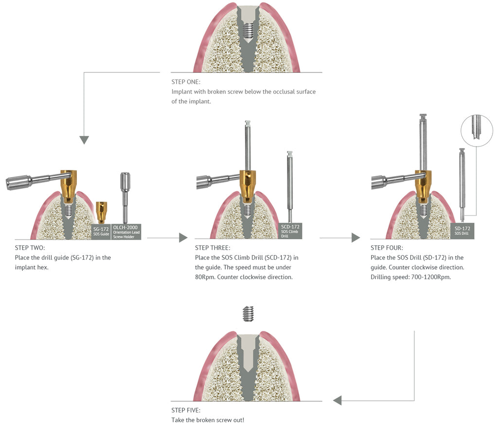 SOS Broken Screw Kit | Surgical | Seven & Lance Plus Compatible | MIS