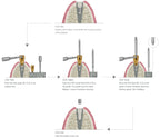 SOS Broken Screw Kit | Surgical | Seven & Lance Plus Compatible | MIS
