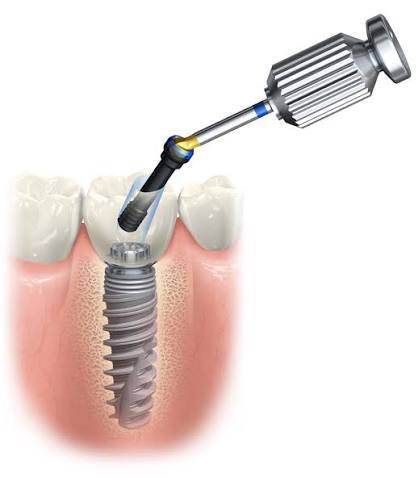 Angled Prosthetic Screw channel abutment