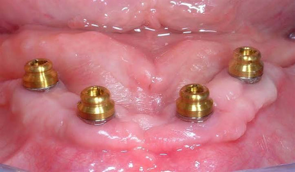 Locator Abutment