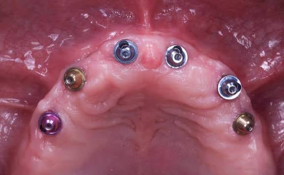 Multiunit Abutment
