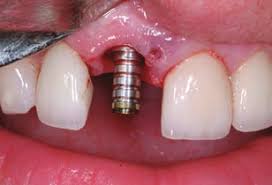 Temporary Abutment